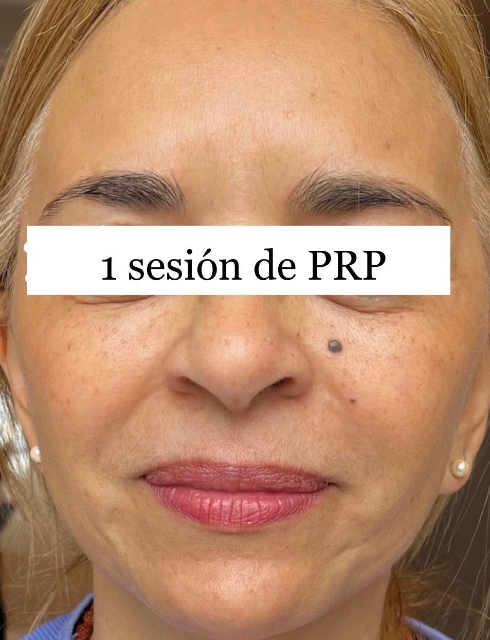 PRP después